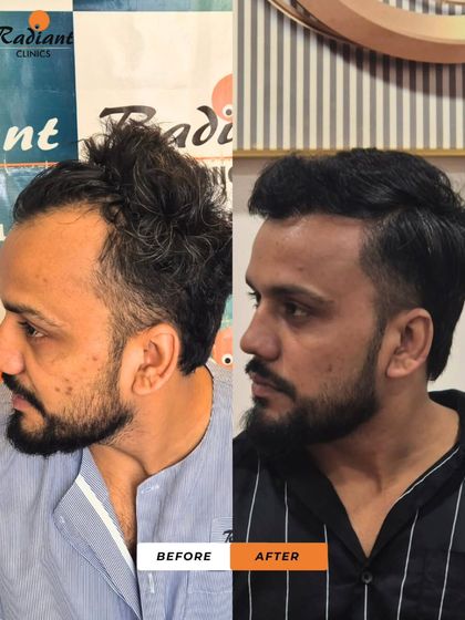 This patient's 'before' photo shows a classic case of a receding hairline and thinning top. The 'after' photo reveals a stylish, dense, and youthful head of hair that has turned back the clock.