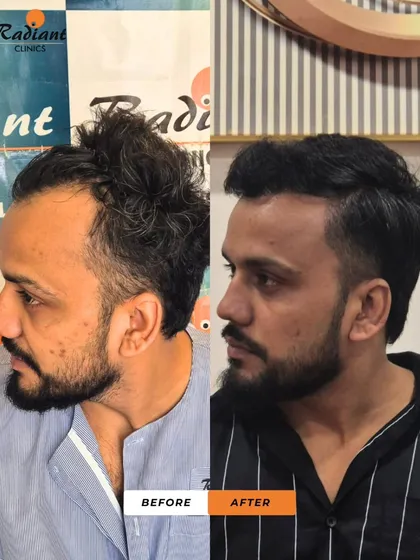 This patient's 'before' photo shows a classic case of a receding hairline and thinning top. The 'after' photo reveals a stylish, dense, and youthful head of hair that has turned back the clock.