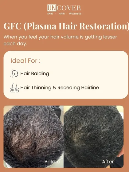 The proof is in the results. This patient saw a significant increase in hair density and coverage after GFC sessions at our clinic. We focus on creating personalized treatment plans because hair restoration is a journey, and results like these are our shared goal.
