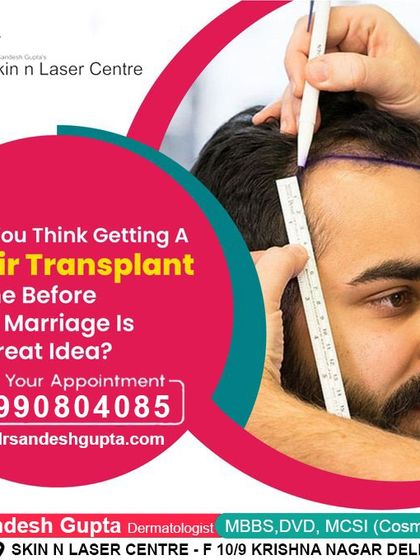 Getting a hair transplant before a big life event like a wedding is a great idea, but it requires planning. I help patients time their procedure to ensure they look their best for their special day.