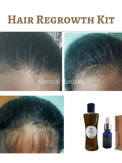This is a wonderful six-month progress photo from a customer using my Hair Regrowth Kit, which includes the oil, serum, and a neem comb. It shows how steady use can lead to visible hair regrowth and a fuller hairline.