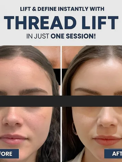 A thread lift offers a fantastic non-surgical option for lifting and tightening the skin. You can see the immediate improvement in facial contours and reduction in sagging in this before and after result.