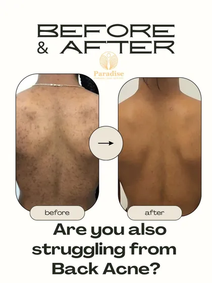 Back acne is a common struggle, but you don't have to live with it. This before and after shows a significant improvement, and I can create a personalized plan to help you achieve clear, confident skin.
