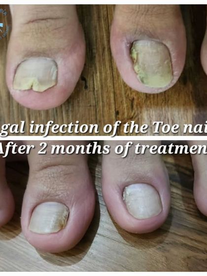 This before-and-after image shows the significant improvement in a fungal toenail infection after just two months of proper treatment. Timely intervention is key, especially for diabetic patients, to prevent complications and restore nail health.