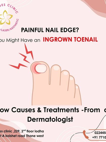 A painful, red edge on your toenail is often a sign of an ingrown nail. If left untreated, this can lead to infection. I provide simple, in-clinic procedures to safely correct the ingrown portion and provide immediate relief.