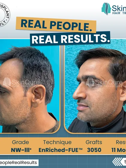 A side view of the 39-year-old patient's 11-month result. This angle demonstrates the natural hairline design and the seamless integration of the transplanted hair.