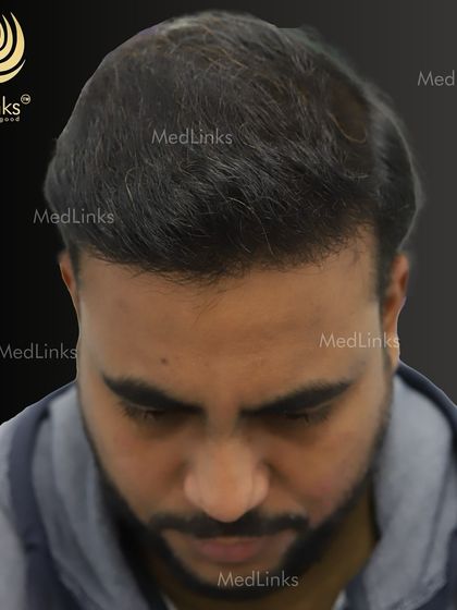 The top-down view after the transplant, showcasing the full coverage achieved.