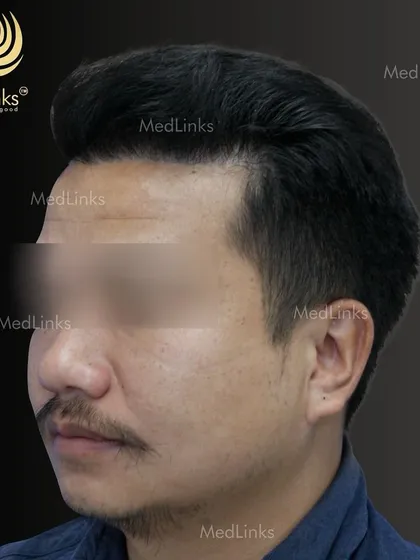 The final result from the side, showing a natural and full hairline.