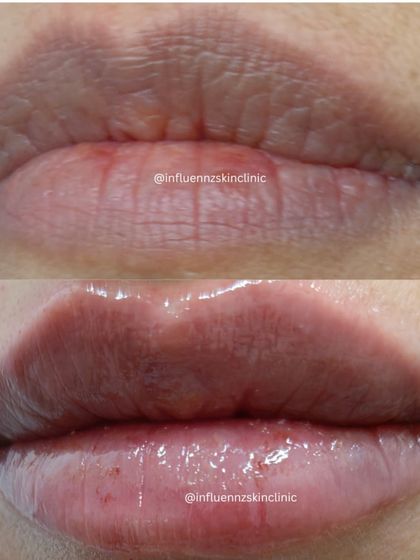 This image shows how lip fillers can not only add volume but also smooth out fine lines on the lips for a rejuvenated look.