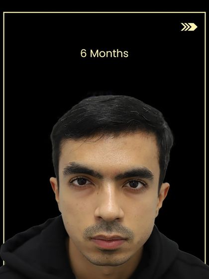 At 6 months, Gaurav's hair shows significant density and growth, well on its way to the final result.