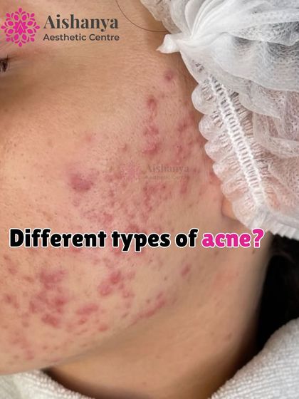This image shows a close-up of different types of acne. Understanding what kind of acne you have is the first step, and I'm here to help diagnose and create the right treatment plan for you.