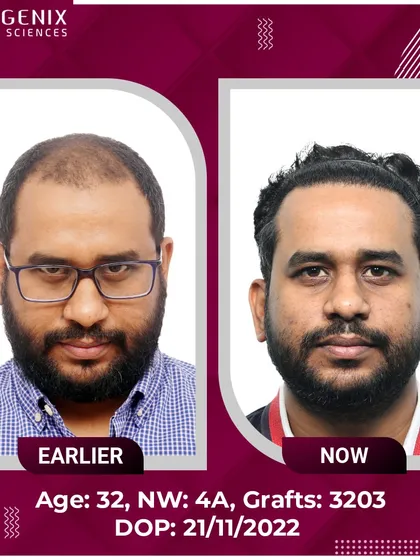The top choice for natural restoration, this 32-year-old's Grade 4A hair loss was treated with 3203 grafts.