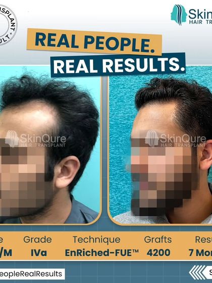 Another side view of the 23-year-old patient's 7-month result. This angle demonstrates the excellent coverage and natural flow of the transplanted hair, even in a case of advanced hair loss.