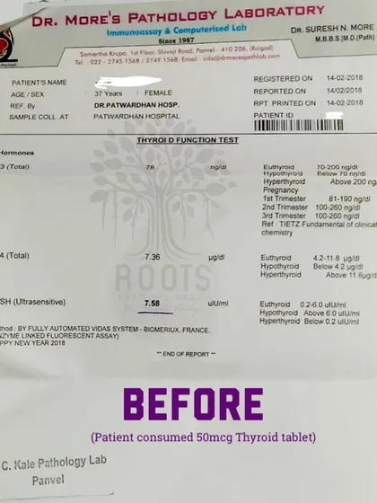 This is a "before" lab report from a patient suffering from hypothyroidism for several years. Even with a 50mcg thyroid tablet, their TSH level was at a high 7.58, indicating the condition was not under control.