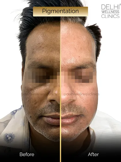 The split-screen comparison emphasizes the dramatic difference our customized pigmentation protocols can make, effectively clearing discoloration.