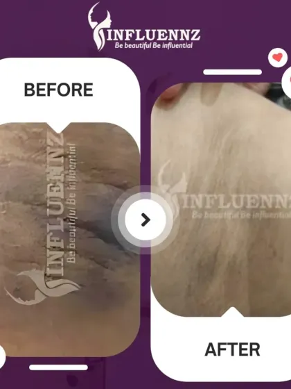 Here is another example of the effectiveness of my underarm brightening solutions. The treatment successfully addressed the dark, textured skin, resulting in a smoother and brighter appearance.