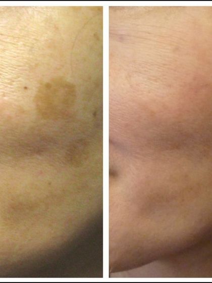 This patient's age spot, a form of sun-induced hyperpigmentation, was successfully treated using targeted laser therapy, resulting in a much clearer and more uniform skin surface.