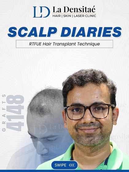 This post documents Hrishikesh Kshirsagar's journey with 4,148 grafts. It's a story about regaining not just hair, but also the self-assurance that comes with feeling good about your appearance.