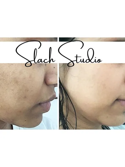 This result shows a significant improvement in skin texture and a reduction in minor blemishes and unevenness.