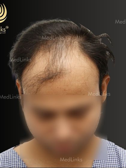 A top-down view of the patient's hair loss before the transplant.