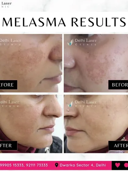 These images show the progressive improvement of melasma over several treatment sessions. Consistency is key, and my goal is to achieve the best possible long-term results for my patients.