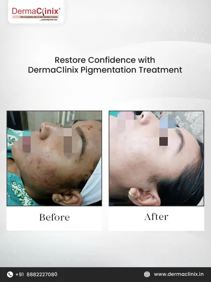 Here you can see a real patient's journey to clearer skin with our pigmentation treatment. We address concerns like melasma and sun damage by targeting excess melanin, resulting in a significantly more even and radiant skin tone.