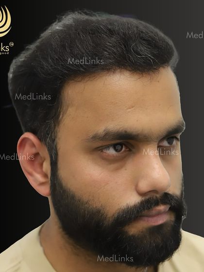 The final result from the side, showcasing a natural and well-defined hairline.