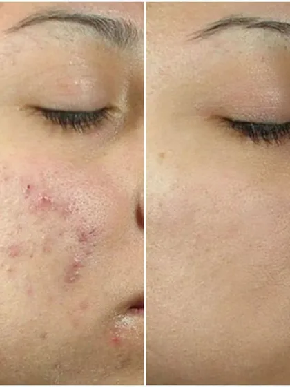 This is a powerful before and after transformation for one of our patients struggling with severe acne and post-inflammatory erythema. Our customized chemical peel treatment plan significantly cleared the breakouts and improved skin texture, revealing healthier skin.