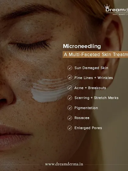 Microneedling is a versatile treatment for a wide range of skin concerns. It is highly effective for sun-damaged skin, fine lines, acne breakouts, scarring, pigmentation, and enlarged pores, making it a cornerstone of our skin renewal programs.
