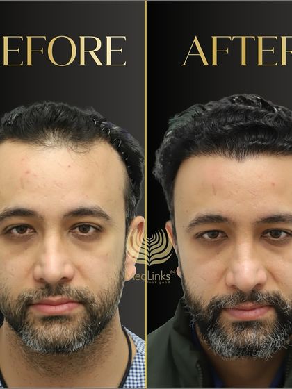 A dramatic before and after. We addressed both the receding hairline and the thinning crown to give this patient a complete and natural-looking hair restoration.