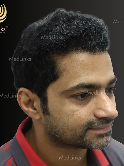 The final result from the side, showing a natural and dense hairline.