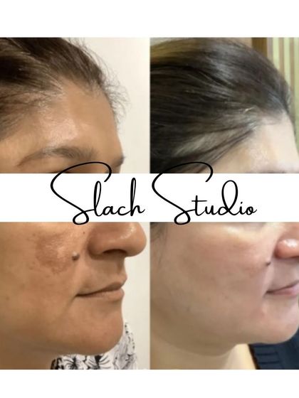 This collage shows the treatment's effectiveness on mature skin, reducing age spots and improving overall skin health.