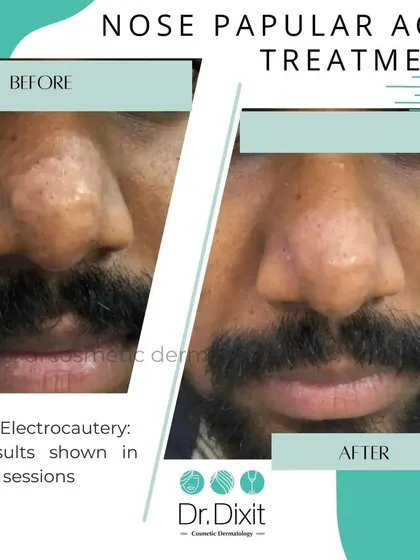 This is a real result from treating papular acne on the nose using RF Electrocautery. This before and after image shows the significant improvement possible with the right procedure. This treatment effectively reduces lesions and improves skin texture over a few sessions.