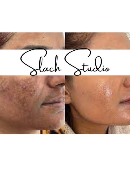 This collage shows a client's journey from pigmented, textured skin to a smooth, glowing complexion.