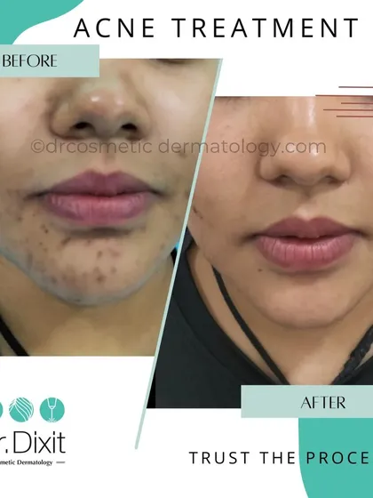 This patient's journey shows how a consistent treatment plan for active acne can prevent future scarring. Trusting the process with prescribed medications and in-clinic procedures leads to clear, healthy skin.