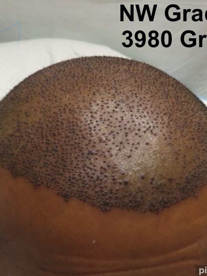 This image shows the immediate post-operative result of a nearly 4000-graft transplant for a patient with Norwood Grade 5 baldness. The hairline has been re-established and the entire balding area has been covered.