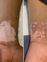 Advanced Vitiligo Treatment