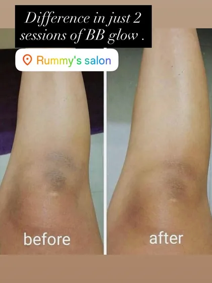BB Glow isn't just for the face. Here, you can see a noticeable lightening of pigmentation on the knees after just two sessions, demonstrating how the treatment can even out skin tone on the body.