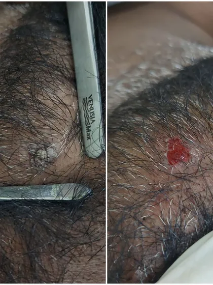 This image displays a direct comparison of a scalp wart before and immediately after removal. The procedure is quick, and as you can see, the growth is completely excised, allowing the skin to begin its healing process right away.