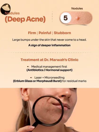 Nodules are a form of deep, painful acne that can be a sign of significant inflammation. We address this with a medical-first approach, often using antibiotics or hormonal support, followed by laser and microneedling for any residual marks.