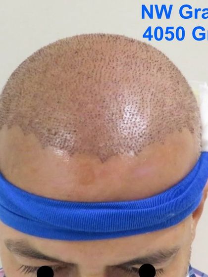 Another successful Giga Session, this time with 4050 grafts to address Grade 5 baldness. These large sessions are cost-effective and provide a complete transformation in a short time frame.