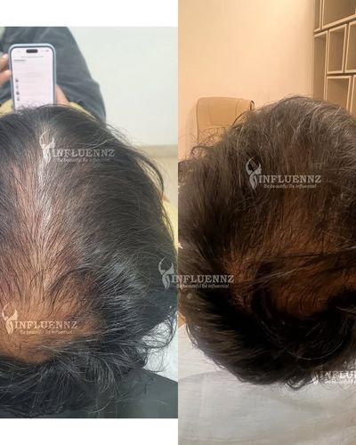 Hair Restoration