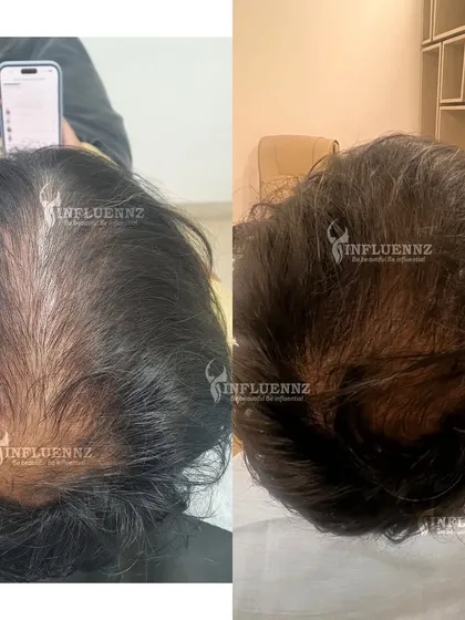 This is the kind of visible result we can achieve. This client's before and after photos show a significant increase in hair density and scalp coverage after completing their personalized hair restoration plan. We focused on reactivating dormant follicles for natural, thicker regrowth.