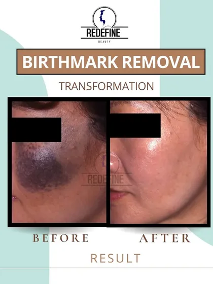 Removing a birthmark can be a life-changing experience. Using advanced laser technology, I can significantly lighten or remove congenital marks, helping my clients feel more comfortable and confident in their own skin.