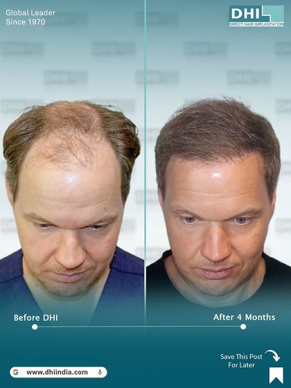 A top-down view of the 4-month progress. This image shows the initial growth phase, highlighting how our DHI technique lays the foundation for a full, dense result in the coming months.