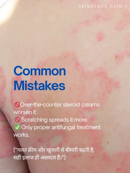 A very common mistake is using over the counter steroid creams on a fungal infection, which actually feeds the fungus and makes it worse. Only a proper antifungal treatment prescribed by a doctor will work.