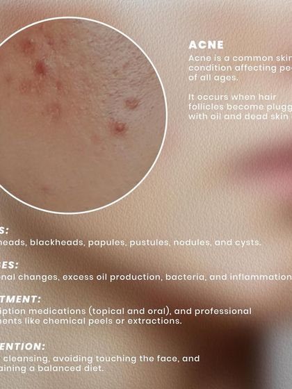 Acne is a common skin condition affecting people of all ages. It's caused by clogged hair follicles and can be treated with prescription medications and professional procedures like chemical peels.