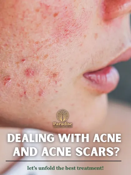 If you're dealing with acne and acne scars, microneedling with a Dermapen is one of the best treatments. It helps reduce inflammation and rebuilds the skin's texture from within.