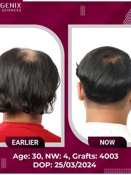 Witness the life-changing results for this 30-year-old after a 4003-graft procedure for Grade 4 baldness.