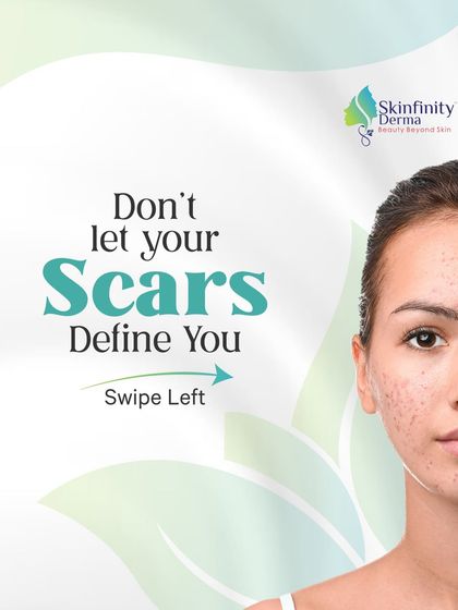Don't let scars define you. Our combination of microneedling, laser treatments, and chemical peels works to stimulate collagen, target pigmentation, and refine skin texture to minimize the appearance of acne scars.